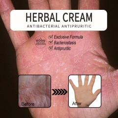 QINGFANGLI Clean and Clear Herbal Cream, effectively treats skin conditions like psoriasis, eczema, and dermatitis. Relieves itching, with notable antibacterial properties. Contains 15g, packaging is box-free.